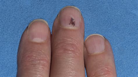 melanoma line under nail